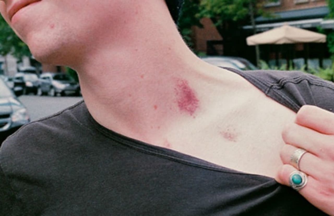 Endzone reccomend giving hickies