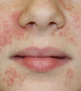 best of Around nose rash Facial