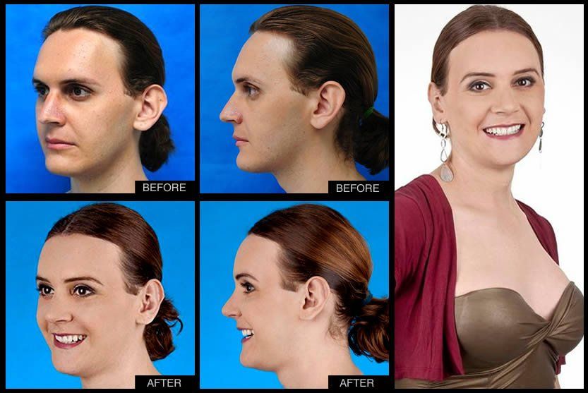 Facial feminization for transsexuals