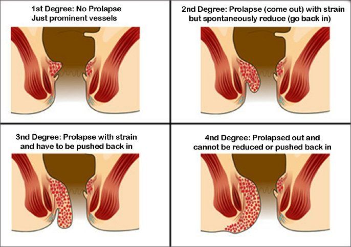 Severe pain in anus