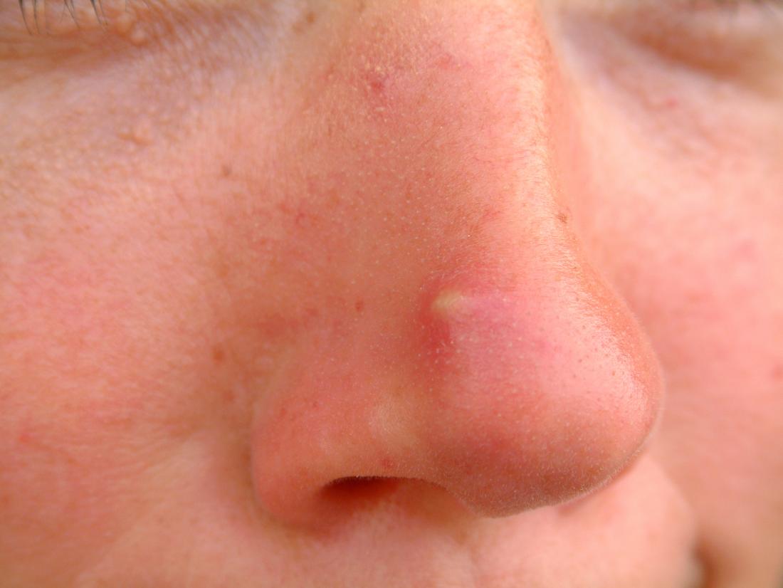 Painful facial bumps