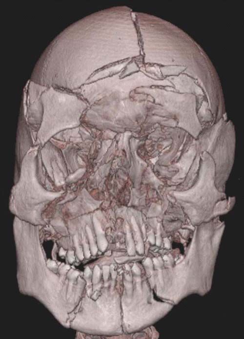 Cali reccomend Complex facial fractures
