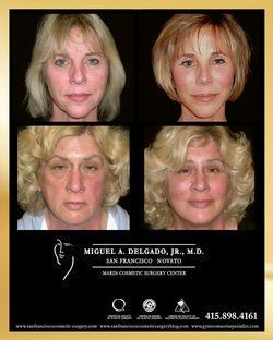 Marin facial plastic surgery