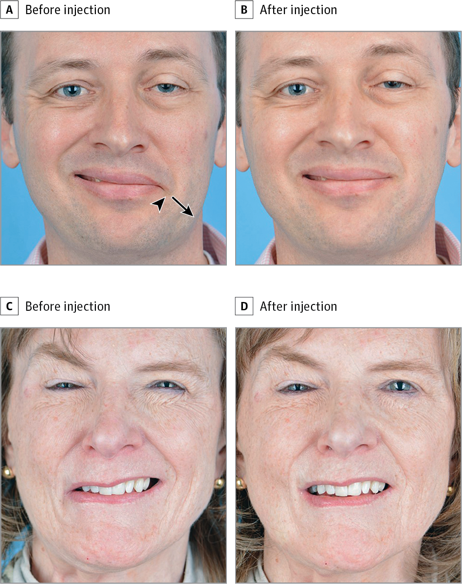 Facial palsy after cocaine use