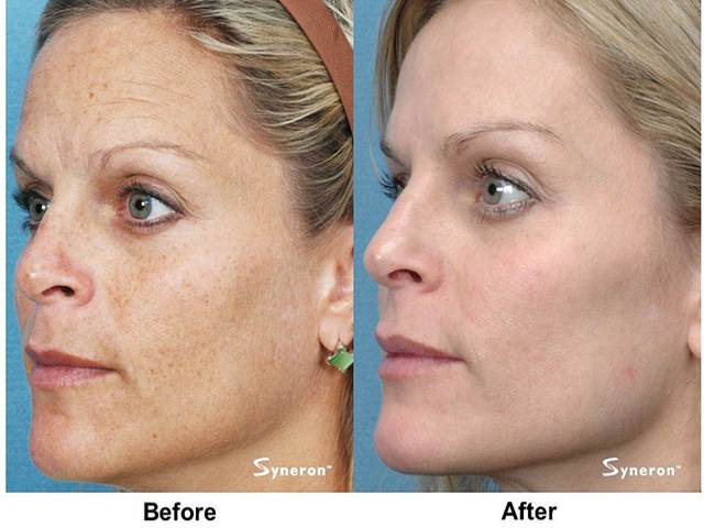 Facial rejuvenation treatments