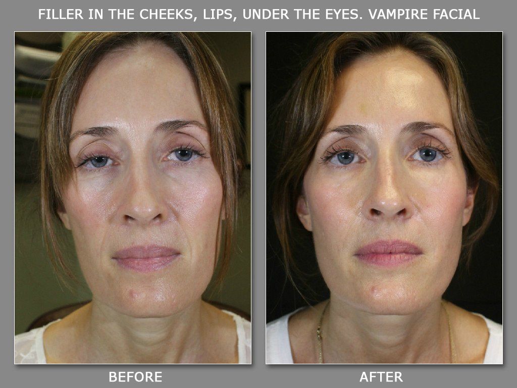 Swelling from facial fillers