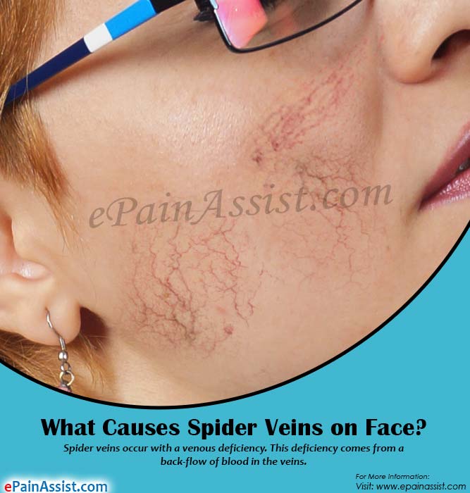 best of Of veins facial rid Get varicose