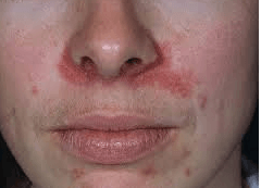 Scarlet reccomend Facial rash around nose