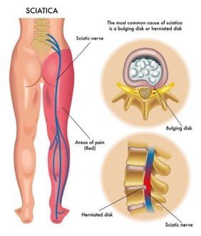 Fibromialgia buttock vagina leg