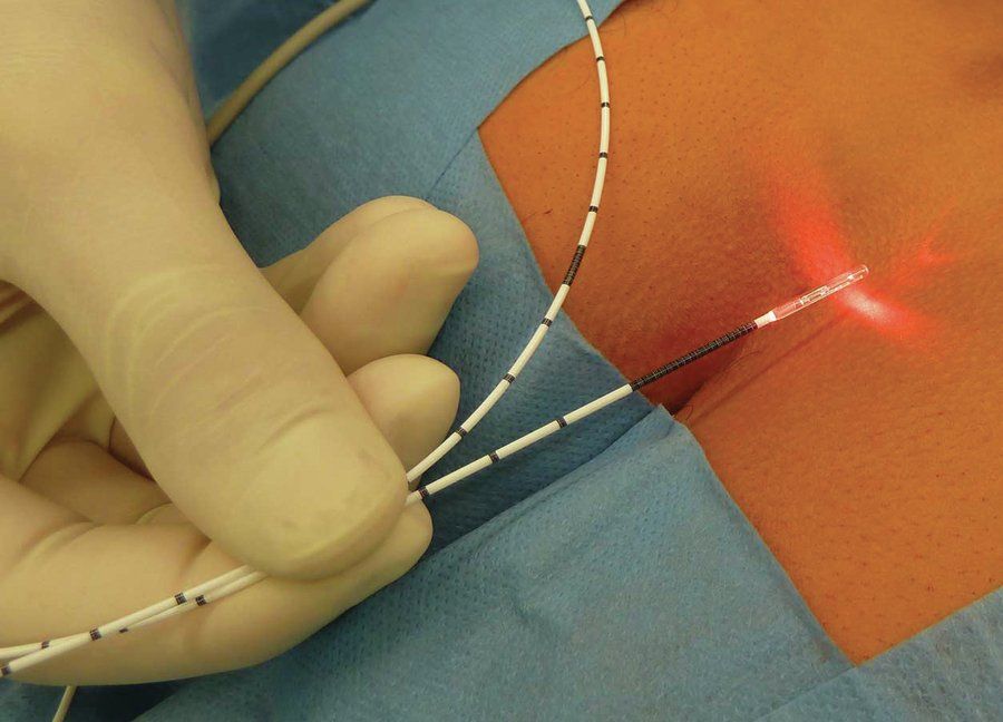 Laser for anal fistulas