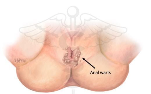 best of Warts Massage anus