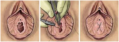 best of Surgery virginity Hymenoplasty