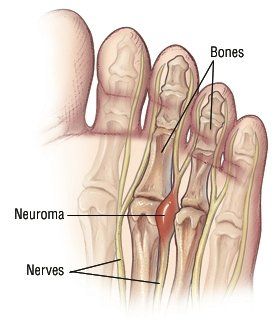 Indominus reccomend Numb area bottom of foot