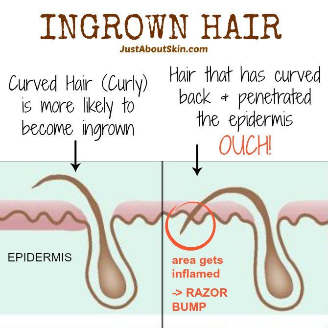 Avoid ingrown hairs bikini