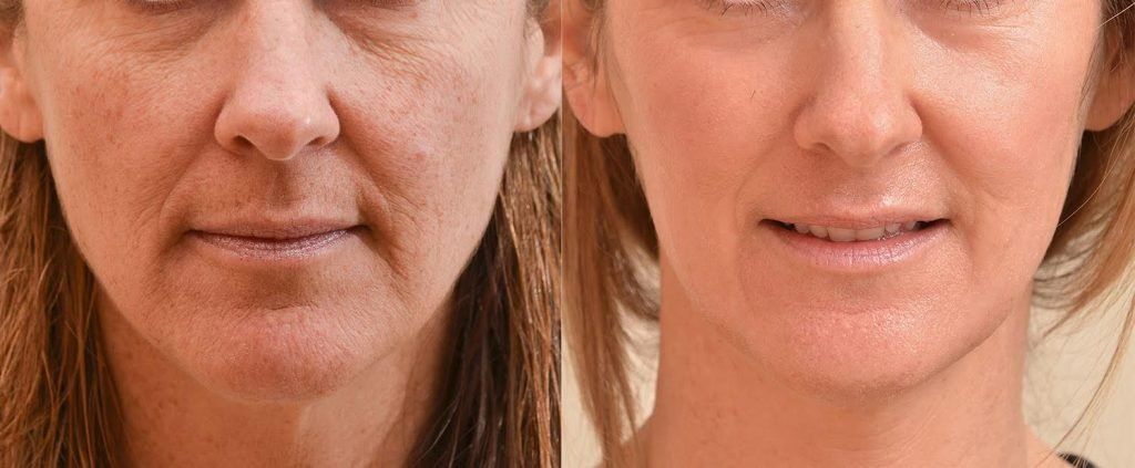 best of With help ruddiness lasers Do facial