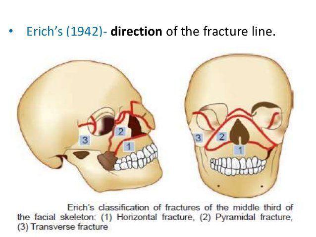 Laser reccomend Complex facial fractures