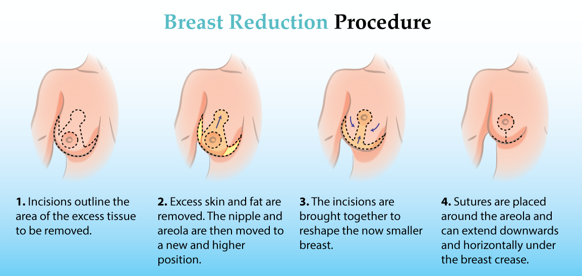 best of Surgery Boob reduction