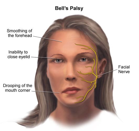 Vet reccomend Recurrent facial nerve palsy