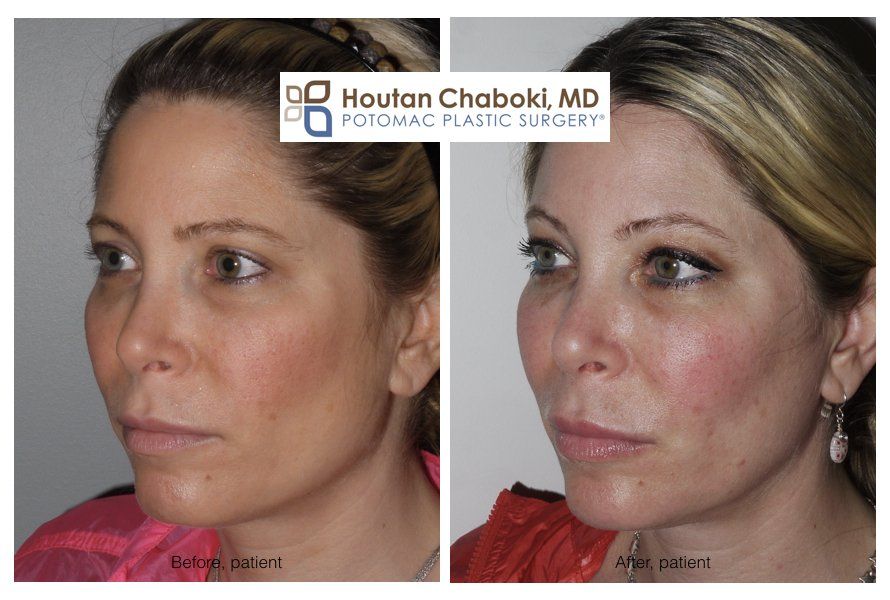 best of From fillers Swelling facial