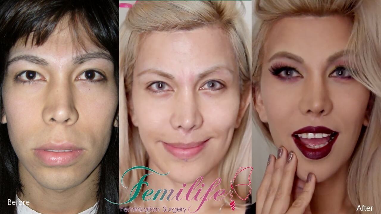 Facial feminization for transsexuals