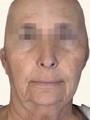 The E. reccomend Geneoplasty facial surgery / tempe, az