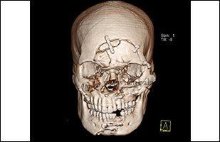 Retrograde reccomend Complex facial fractures