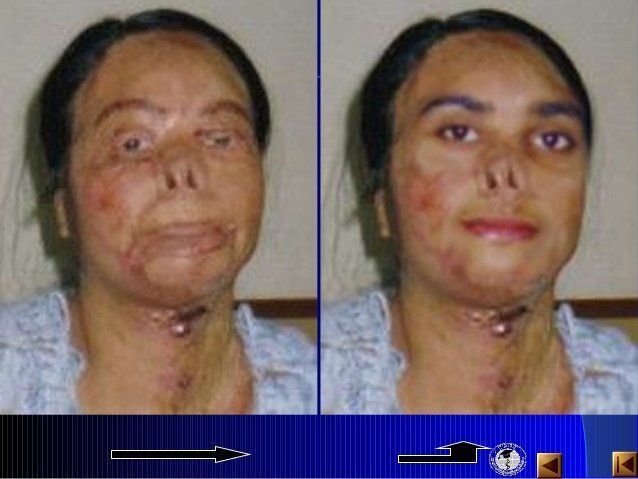 Congo reccomend Facial tissue transplant
