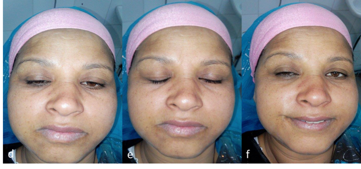 best of Palsy use Facial after cocaine