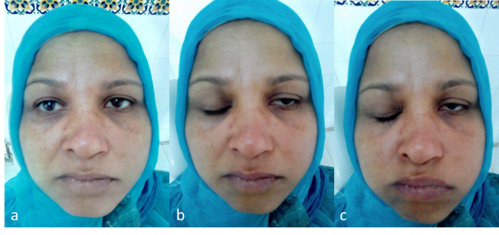 Solstice reccomend Facial palsy after cocaine use