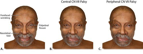 Lunar reccomend Peripheral facial palsy