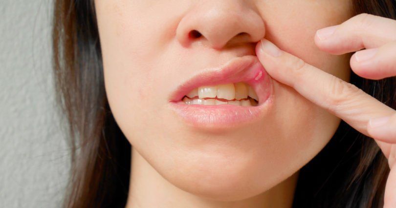 Cancre sores and facial pain