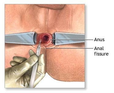 Handyman reccomend Can anal fissure cause severe bleeding