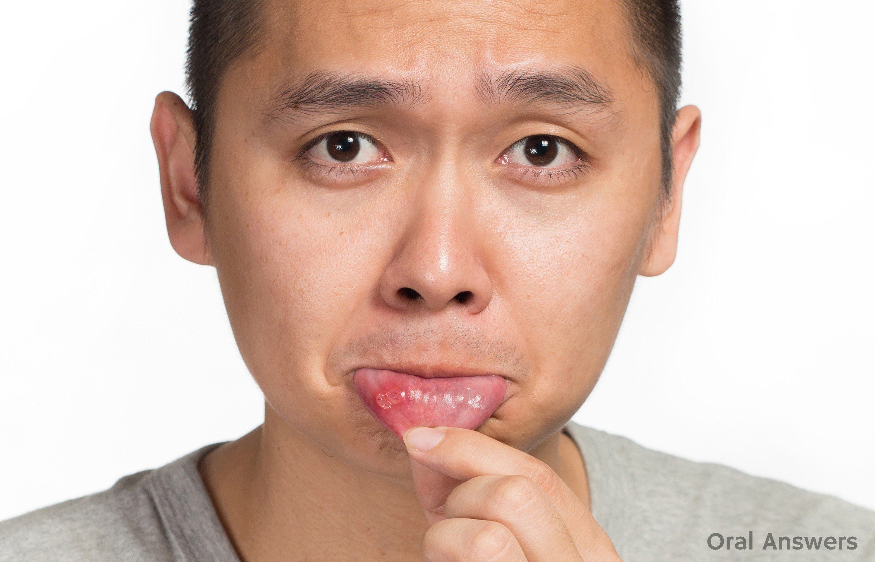 best of Facial pain Cancre sores and