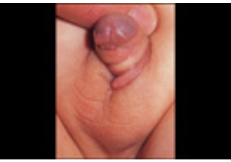 Coma reccomend Clitoris enlarged by testonsterone