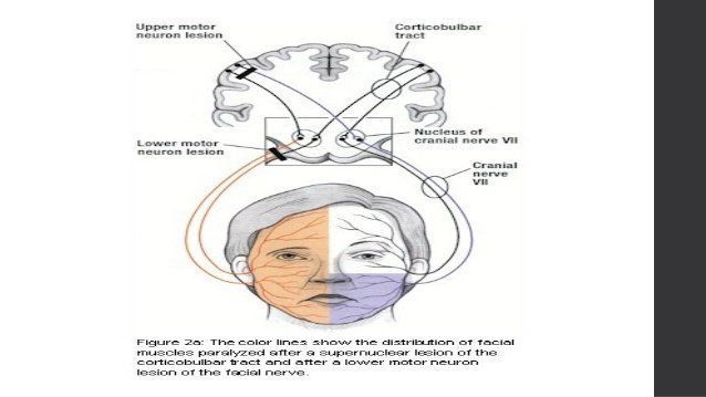 Peripheral facial palsy