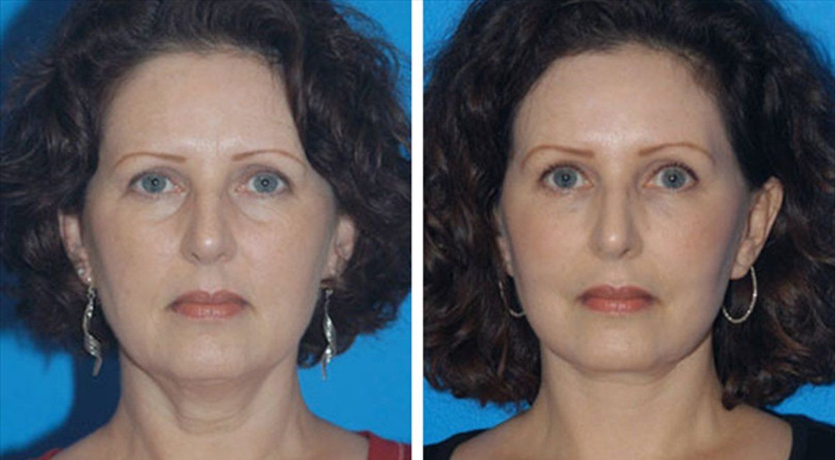 Endoscopic facial surgery