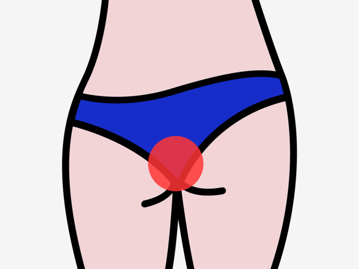 Menstrual bleed from anus