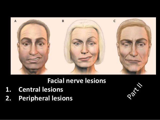 Peripheral facial palsy