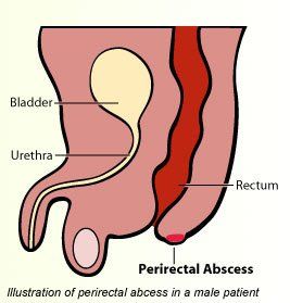 Lump under skin on left side of anus
