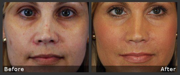 Ribeye reccomend Facial rejuvenation treatments