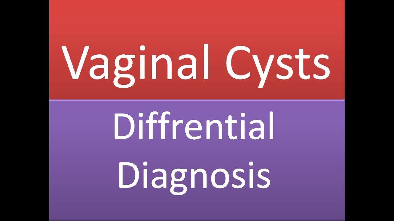 best of Cyst vagina Multiple