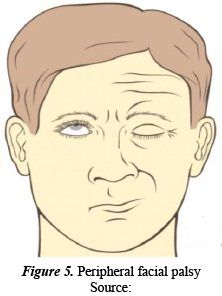 best of Facial palsy Peripheral