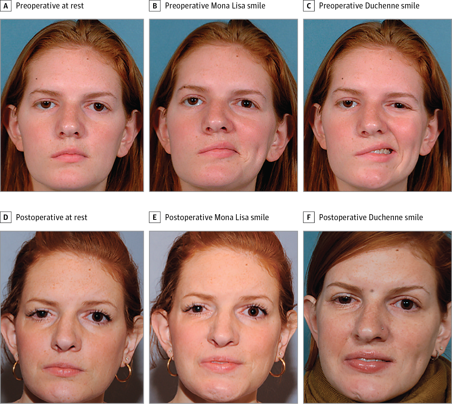 best of Nerve Markers for facial