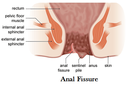 Anal fissure and relief
