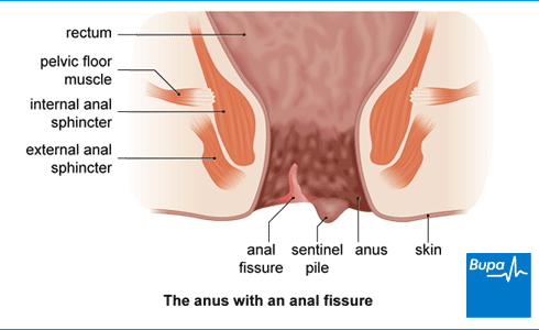 Retrograde reccomend Anal fissure and relief