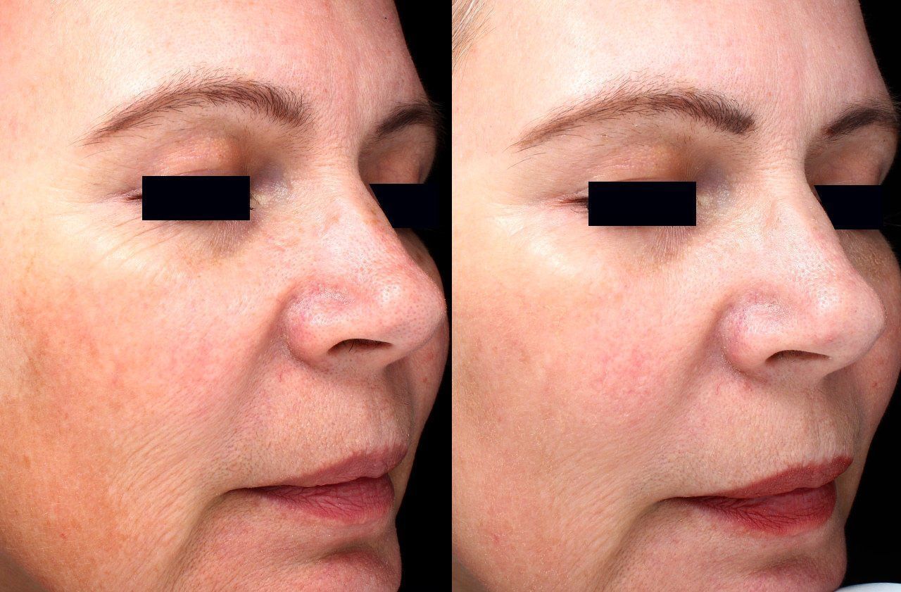 best of Skin tightening facial Cynosure elite