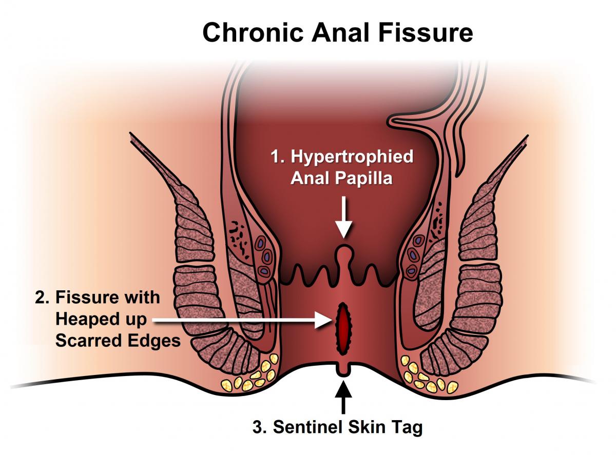 Trouble reccomend Can anal fissure cause severe bleeding