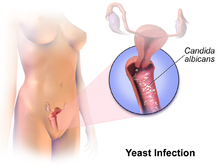 best of Infection Clitoris yeast