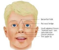 Cranial facial syndrome velo