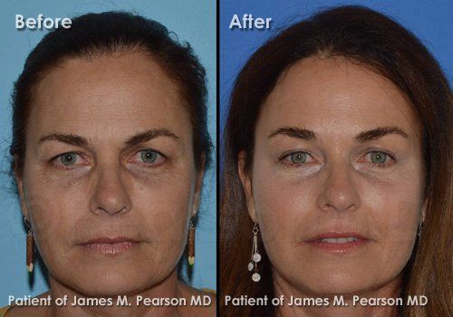 best of Facial surgery Endoscopic